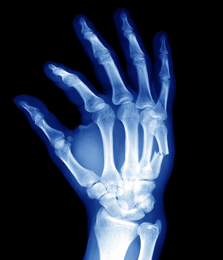Why Hire a Personal Injury Attorney for a Broken Hand?