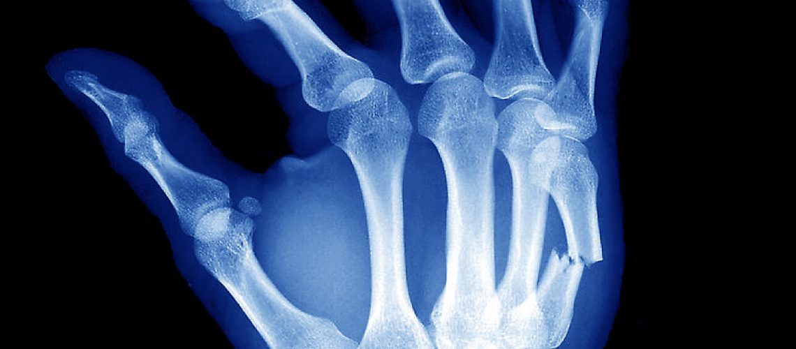 Why Hire a Personal Injury Attorney for a Broken Hand?